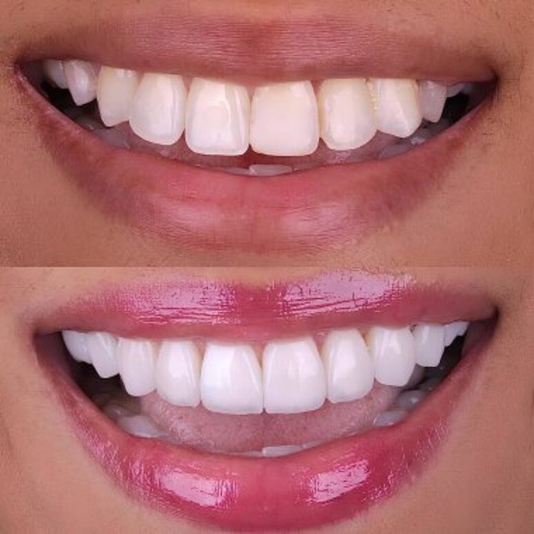 depositphotos_781508490-stock-photo-aesthetic-smile-design-treatment-dental.jpeg depositphotos_781508490-stock-photo-aesthetic-smile-design-treatment-dental.jpeg