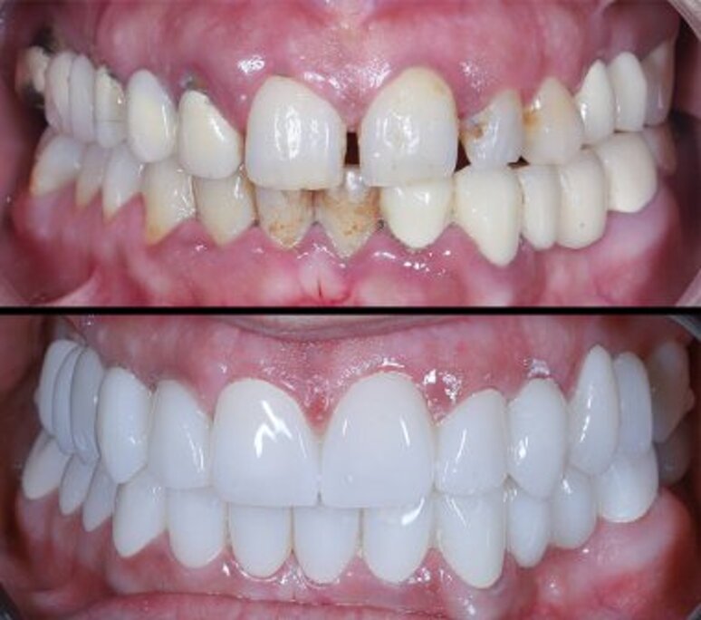 depositphotos_782546462-stock-photo-aesthetic-dentistry-max-zirconium-porcelain.jpeg depositphotos_782546462-stock-photo-aesthetic-dentistry-max-zirconium-porcelain.jpeg