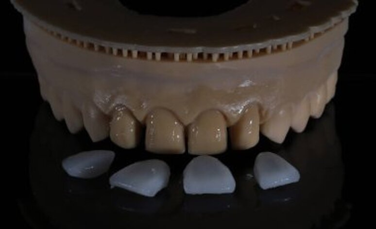 depositphotos_781500526-stock-photo-glass-ceramic-dental-porcelain-crowns.jpeg depositphotos_781500526-stock-photo-glass-ceramic-dental-porcelain-crowns.jpeg