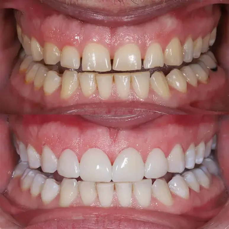 depositphotos_781503832-stock-photo-restoration-discolored-broken-worn-teeth depositphotos_781503832-stock-photo-restoration-discolored-broken-worn-teeth