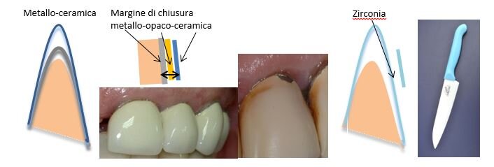 zirconia