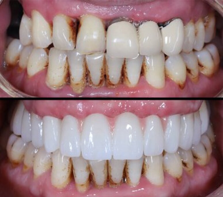 depositphotos_782546548-stock-photo-smile-makeover-full-arch-dental.jpeg depositphotos_782546548-stock-photo-smile-makeover-full-arch-dental.jpeg