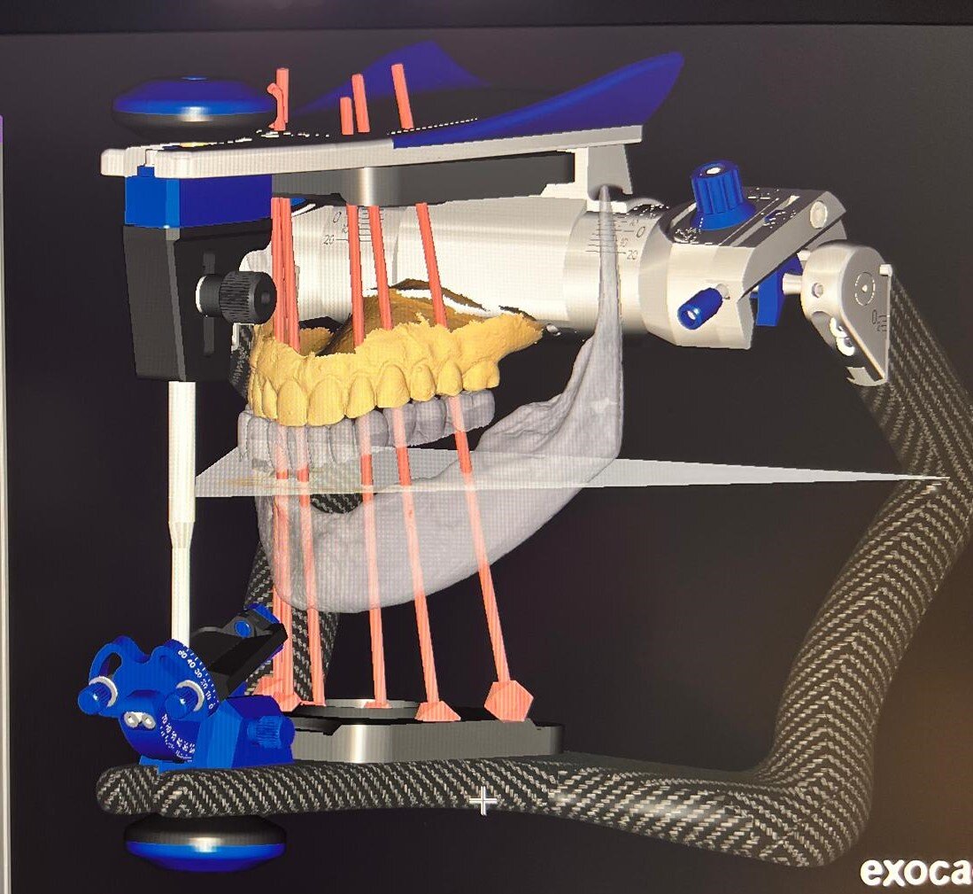 IMPIANTI SOTTO PERIOSTEI: L'IMPORTANZA DI UNA OCCLUSIONE DENTALE BILANCIATA