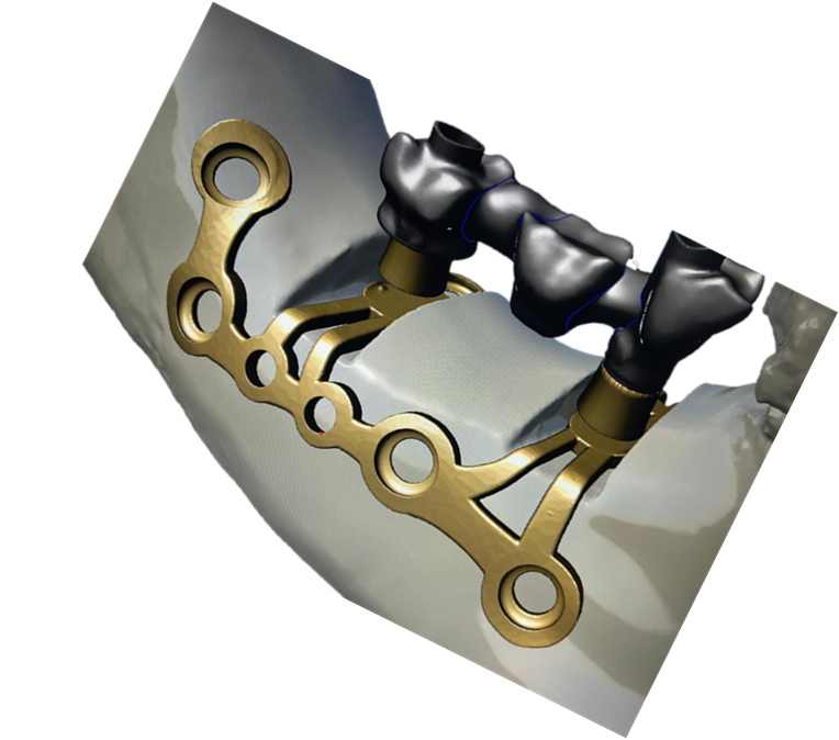 IMPIANTI SOTTO PERIOSTEI QUELLO CHE C'E' DA SAPERE