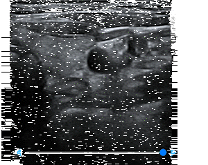 thyroid-hypertrophic-follicle