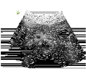 intraductal-pancreatic-mucinous-neoplasm