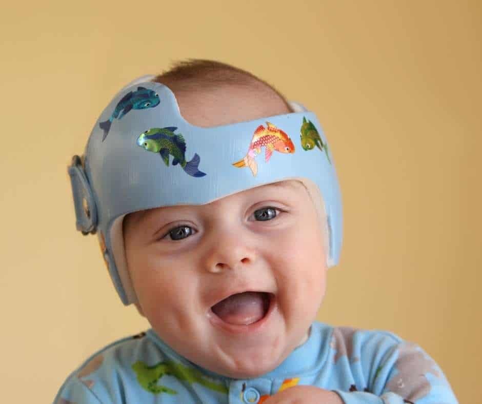 La Plagiocefalia, tutto quello che &egrave; da sapere.