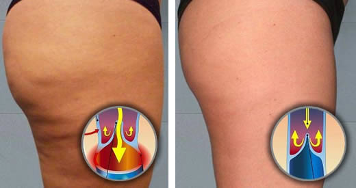 riattivare-circolazione-cellulite.jpg