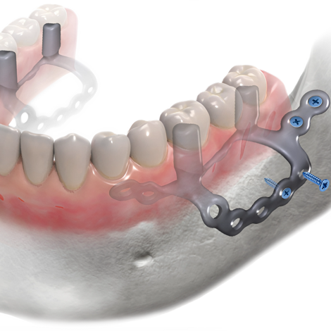 impianti dentali Eaglegrid