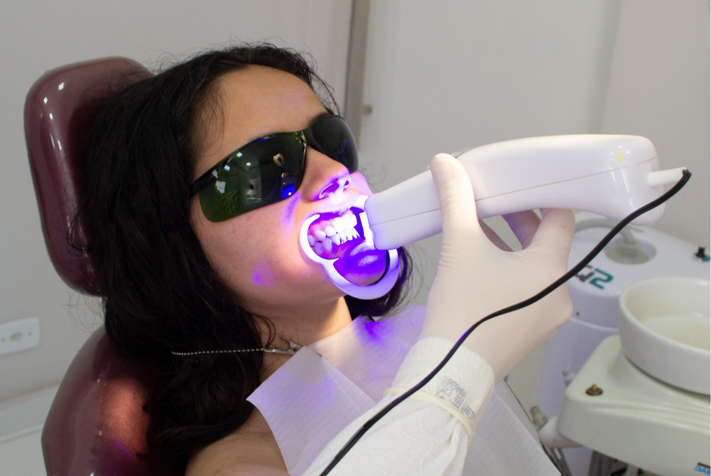 sbiancamento dentale laser