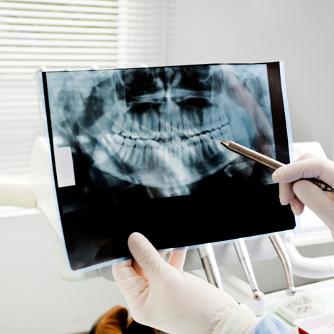 radiografia dentale digitale