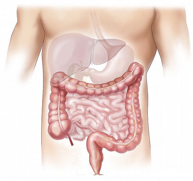 Dostarlimab, sparisce il tumore al colon in 12 pazienti. La svolta?