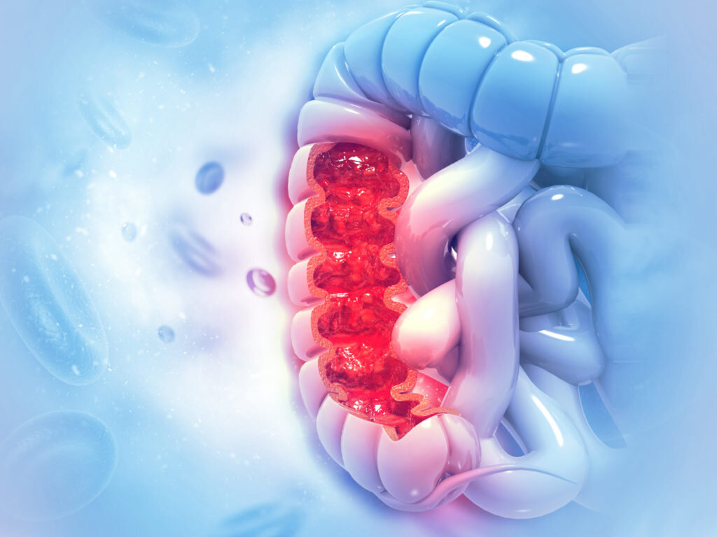 Microbiota intestinale, sinbiotici e carcinoma colorettale Microbiota intestinale, sinbiotici e carcinoma colorettale
