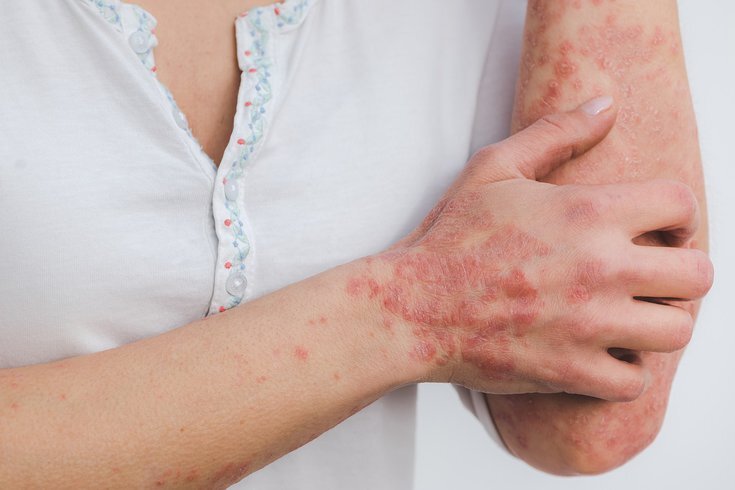 Psoriasi e microbiota intestinale: stato dell'arte Psoriasi e microbiota intestinale: stato dell'arte