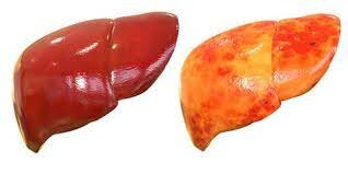 Celiachia e steatosi epatica non alcolica
