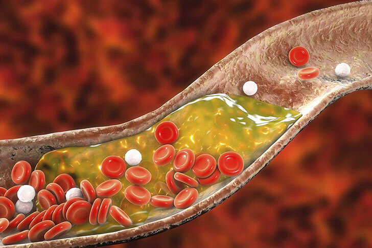 Il paradosso israeliano: limiti del paradigma colesterolo-centrico nella prevenzione cardiovascolare