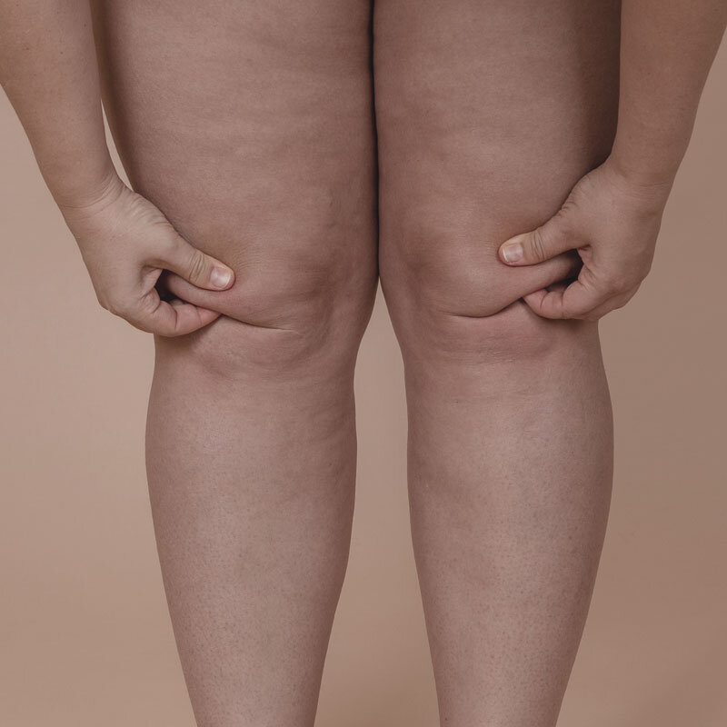 Lipedema: estrogeni, infiammazione e permeabilit&agrave; intestinale.