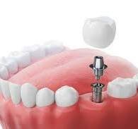 IMPIANTOLOGIA DENTALE
