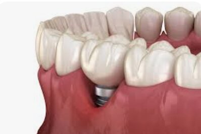 DOPO GLI IMPIANTI NON CI PENSO PIU'? AVRO' LA PERIMPLANTITE? DOPO GLI IMPIANTI NON CI PENSO PIU'? AVRO' LA PERIMPLANTITE?