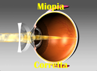 miopiacorretta