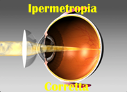 iermetropiacor
