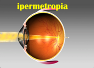 ipermetropia