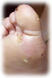 verrucheplantari_02