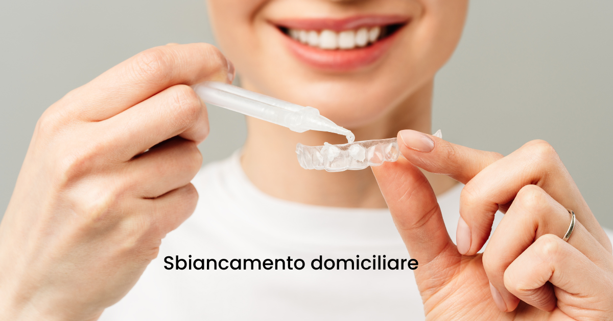 Applicazione del gel per lo sbiancamento dentale domiciliare nella mascherina personalizzata