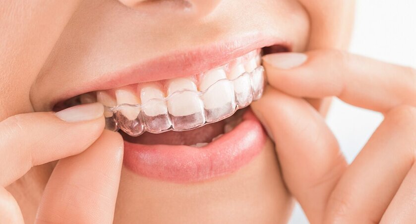 invisalign-pro-e-contro-1170x630.jpeg