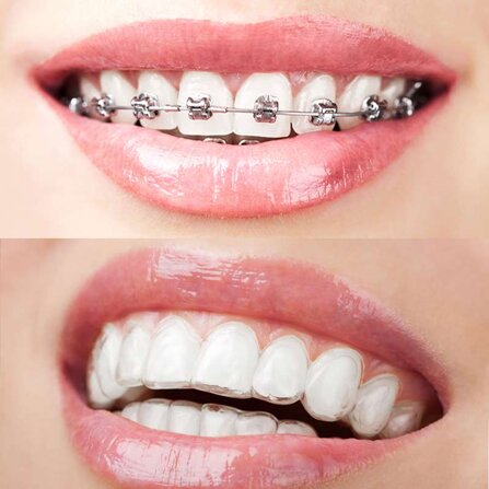 confronto-estetica-invisalign-apparecchio.jpeg