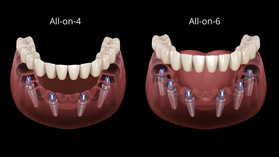 all-on-4-i-all-on-6.jpeg all-on-4-i-all-on-6.jpeg