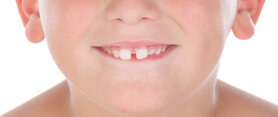 diastema-nei-bambini.jpeg