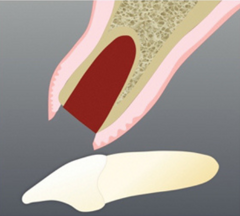 implantologia-dentale-post-estrattiva-con-carico-immediato implantologia-dentale-post-estrattiva-con-carico-immediato