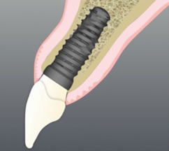 implantologia-dentale-post-estrattiva-con-carico-immediato (1)