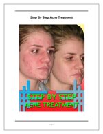 step-by-step-acne-treatment