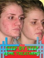 step-by-step-acnetreatment