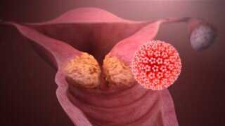 Dopo 8 anni di sospensione e un&rsquo;ondata crescente di patologie tumorali, il Giappone reintroduce la raccomandazione sulla vaccinazione per l&rsquo;HPV: l&rsquo;importanza della prevenzione e sensibilizzazione vaccinale.