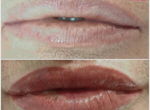 riempimento labbra con 