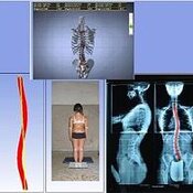 Scoliosi Giovanili Scoliosi idiopatica in età evolutiva Morbo di Scheuermann in età evolutiva Spondilolistesi