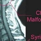 Pubblicazioni Sindrome Arnold-Chiari e Siringomielia:Danni secondari e percorsi riabilitativi
