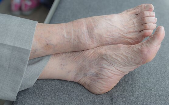 Trattamento terapeutico della sindrome del piede diabetico