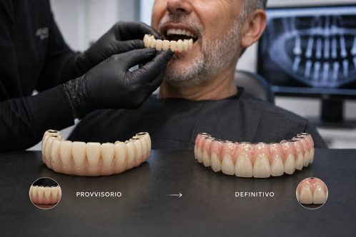 strutture su impianti laboratorio odontotecnico