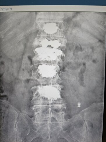 2026-03-13 rx colonna anteroposteriore.jpeg