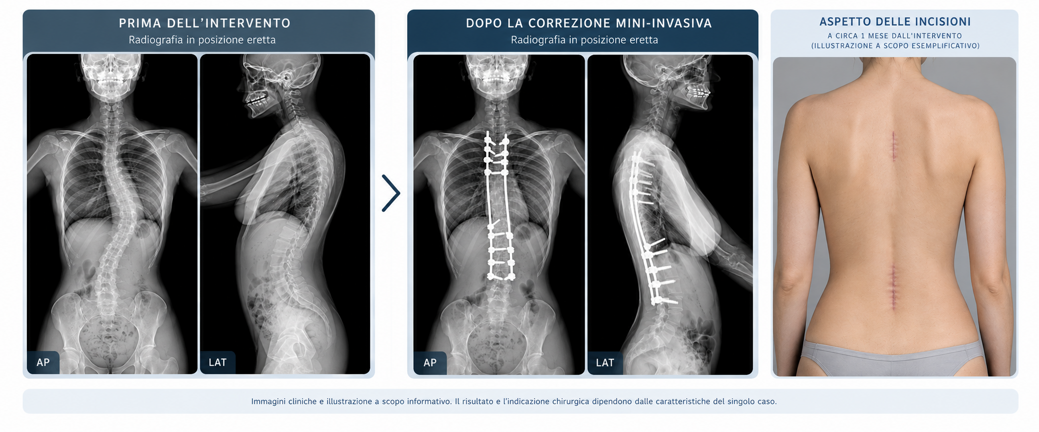 radiografie pre e post trattamento della scoliosi e illustrazione incisioni radiografie pre e post trattamento della scoliosi e illustrazione incisioni