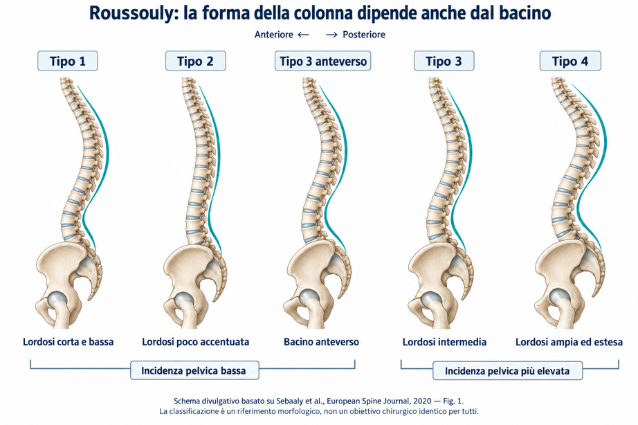 Classificazione di Roussouly Classificazione di Roussouly