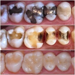 amalgamfillings1.jpeg