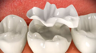 ceramic-inlay-procedure-demonstration.jpeg