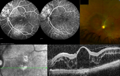 scansione oct retina