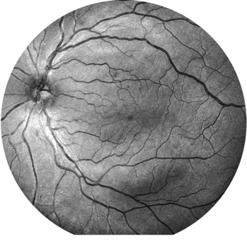 diabetic-retinopathy diabetic-retinopathy