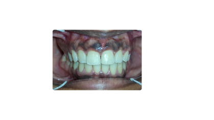 dopo l trattamento con mascherine dopo l trattamento con mascherine